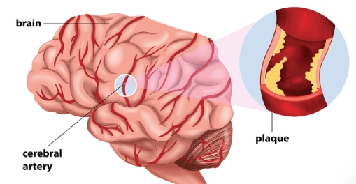 Cerebrovascular Disease Protection Of Oxysophoridine Cerebrovascular Disease Protection Of Oxysophoridine